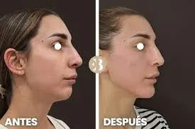 Marcación mandibular: precisión, luz y equilibrio en el contorno facial